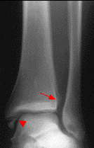radiografia esguince.gif